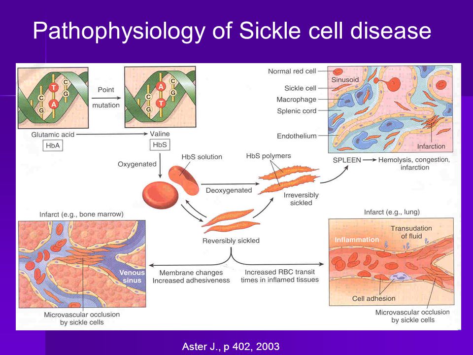 Pathophysiology of Sickle cell disease