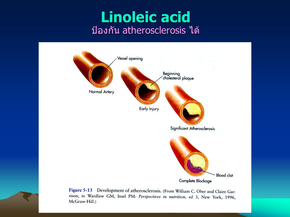 Linoleic acid ป้องกัน atherosclerosis ได้