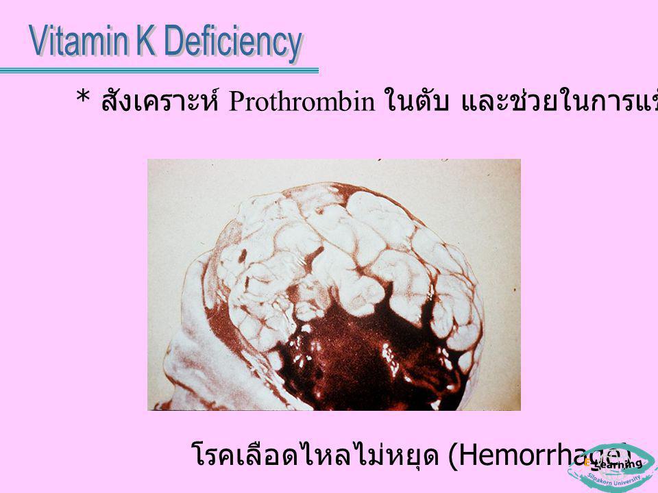 Vitamin K Deficiency * สังเคราะห์ Prothrombin ในตับ และช่วยในการแข็งตัวของเลือด.