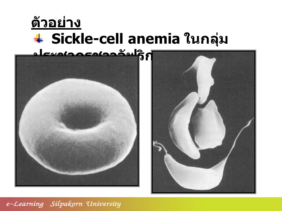 ตัวอย่าง Sickle-cell anemia ในกลุ่มประชากรชาวอัฟริกา