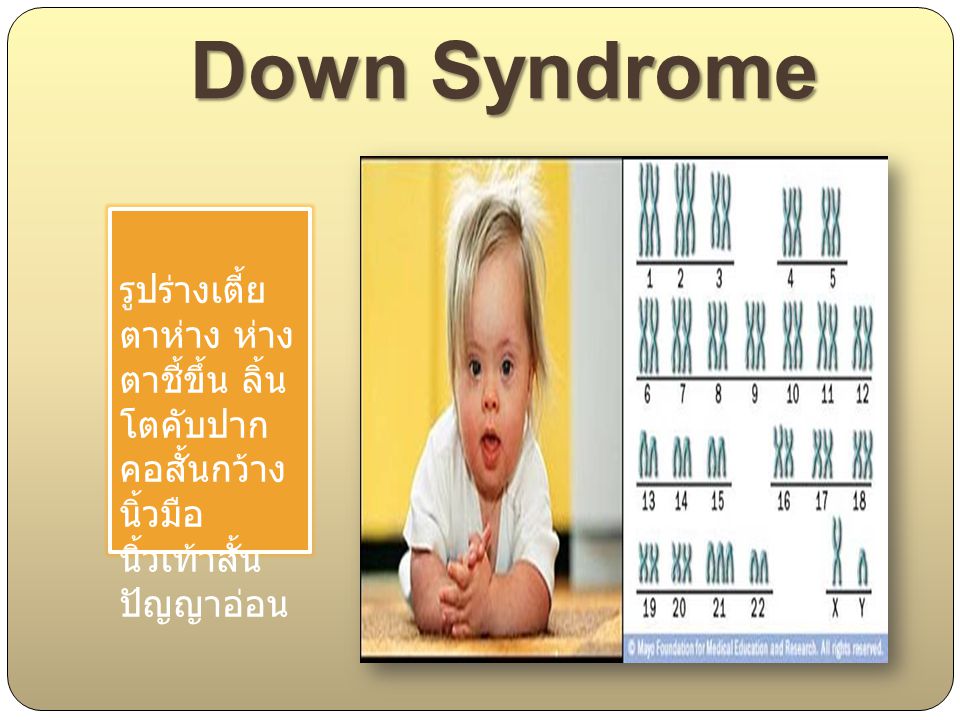 Down Syndrome รูปร่างเตี้ย ตาห่าง ห่างตาชี้ขึ้น ลิ้นโตคับ ปาก คอ สั้นกว้าง นิ้วมือ นิ้วเท้าสั้น ปัญญาอ่อน.