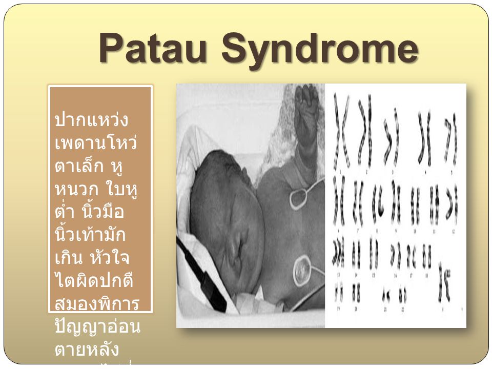 Patau Syndrome ปากแหว่ง เพดานโหว่ ตาเล็ก หู หนวก ใบ หูต่ำ นิ้ว มือนิ้วเท้า มักเกิน หัวใจ ไต ผิดปกตื สมองพิการ ปัญญาอ่อน ตายหลัง คลอดไม่กี่ เดือน.