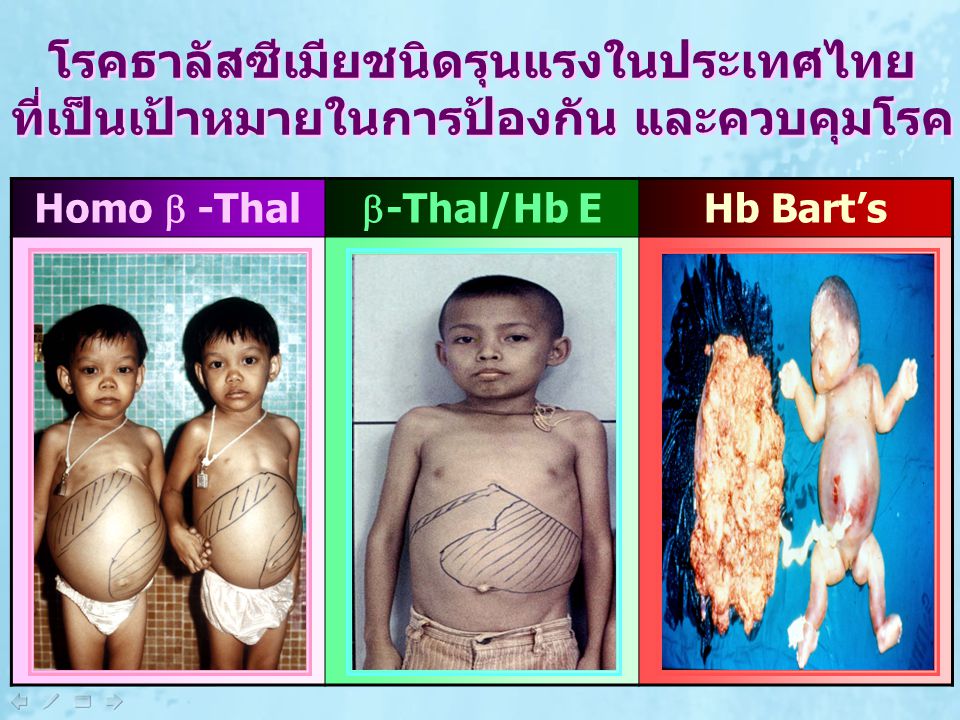 โรคธาลัสซีเมียชนิดรุนแรงในประเทศไทย ที่เป็นเป้าหมายในการป้องกัน และควบคุมโรค
