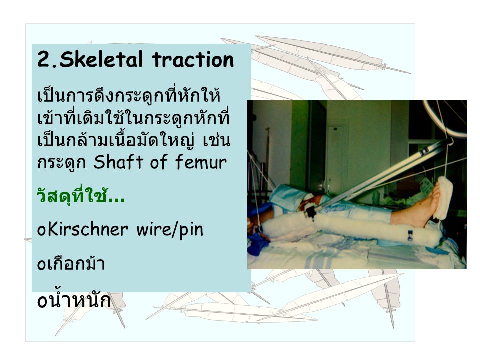 2.Skeletal traction น้ำหนัก