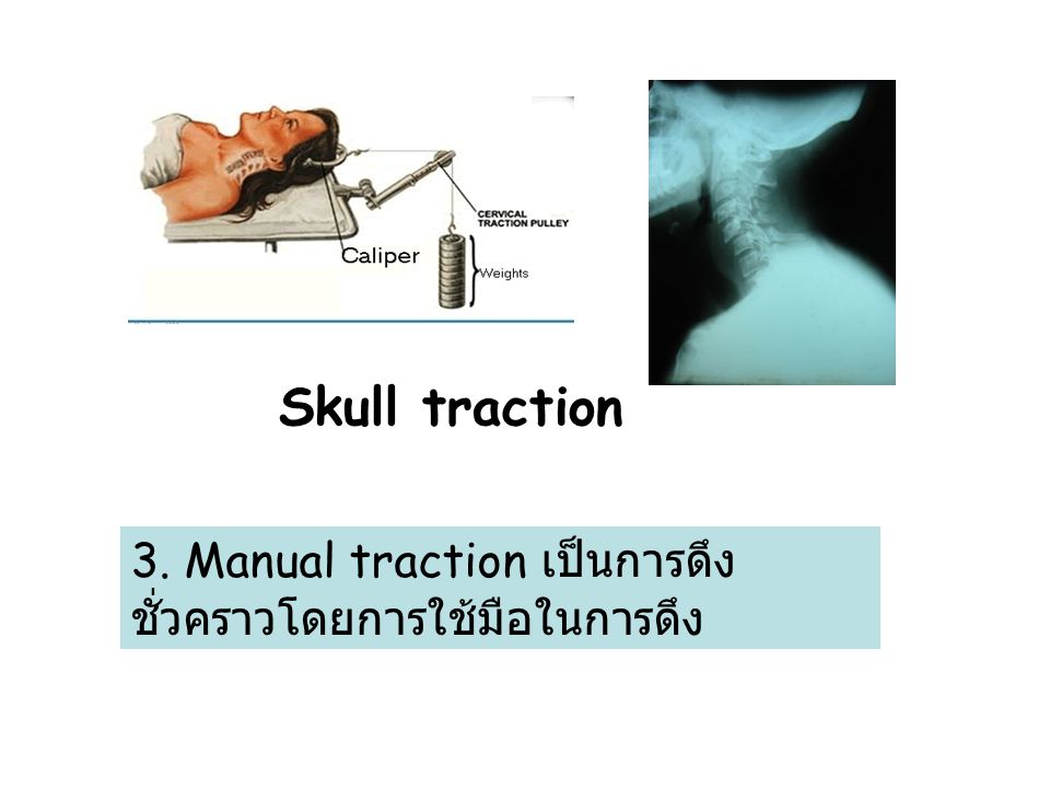 Skull traction 3. Manual traction เป็นการดึงชั่วคราวโดยการใช้มือในการดึง
