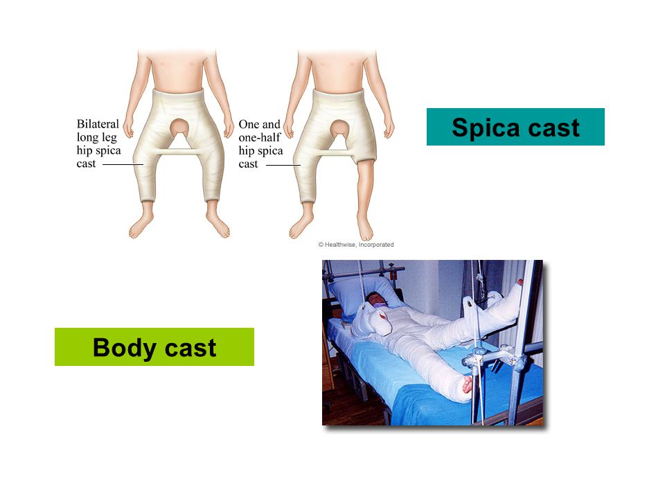Spica cast Body cast