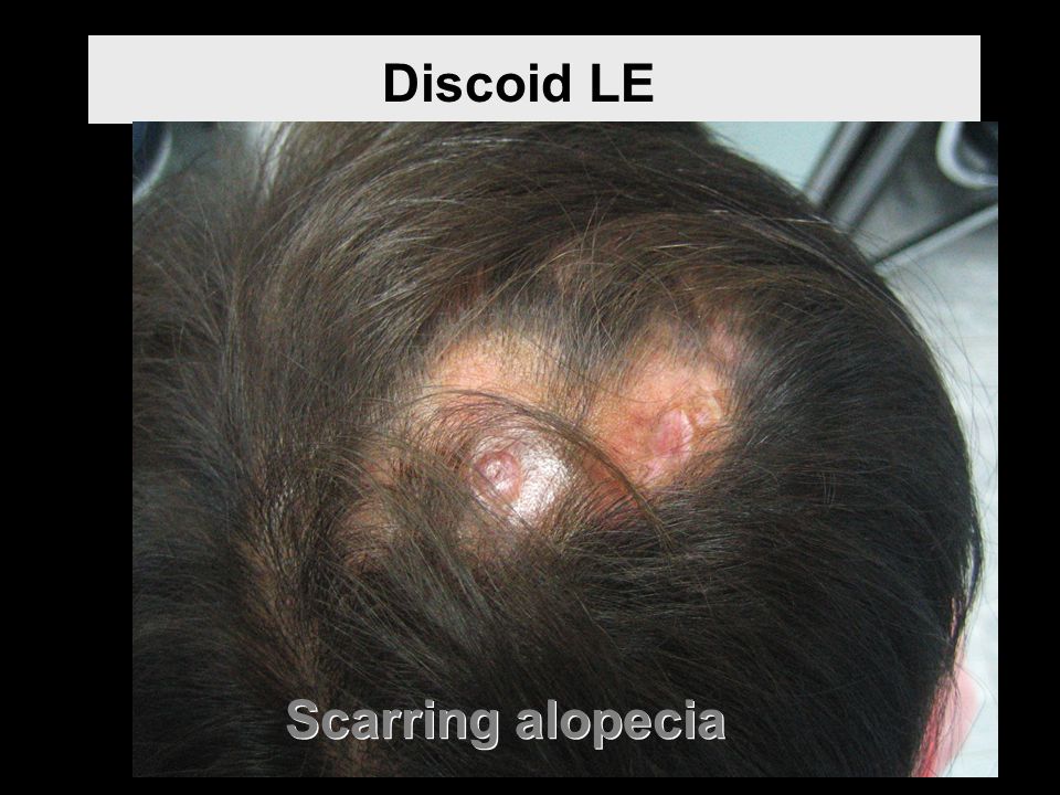 Discoid LE Scarring alopecia