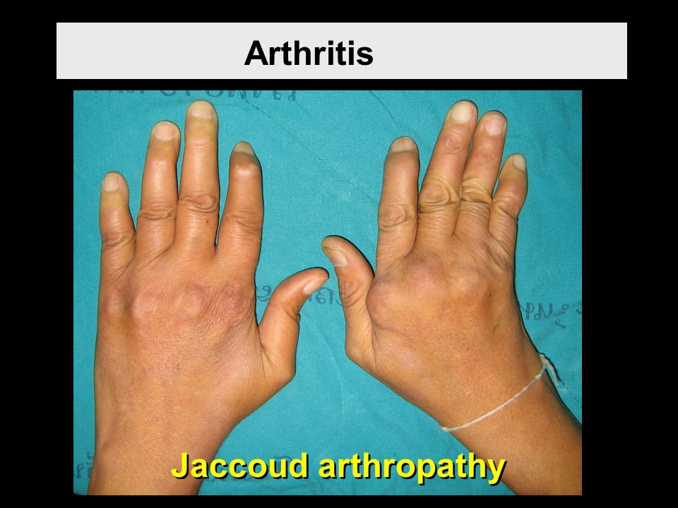 Arthritis Jaccoud arthropathy