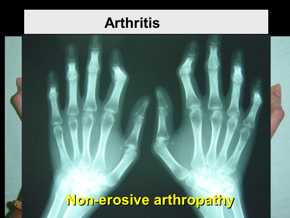 Arthritis Non-erosive arthropathy
