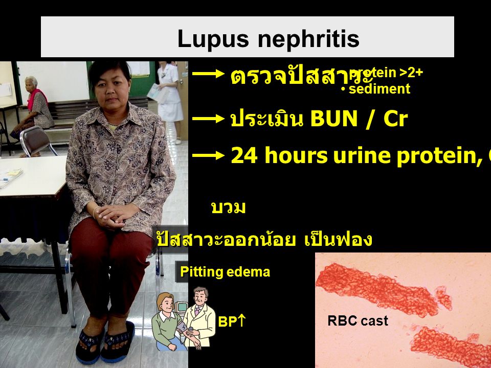 Lupus nephritis ตรวจปัสสาวะ ประเมิน BUN / Cr
