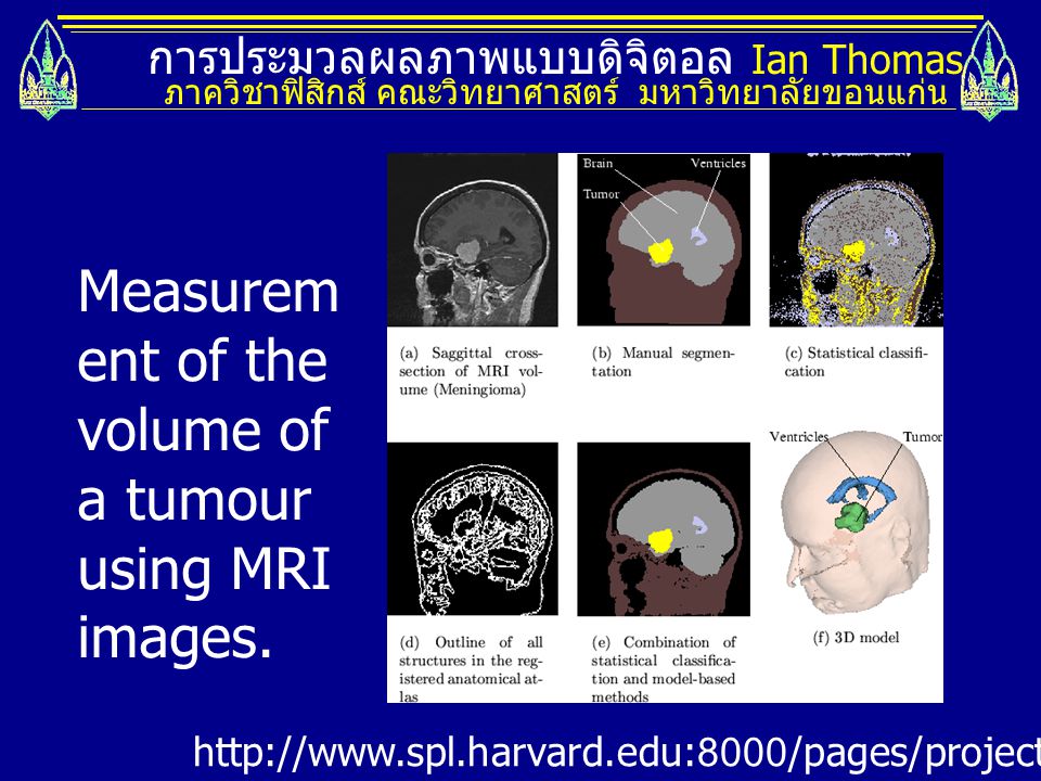 Measurement of the volume of a tumour using MRI images.
