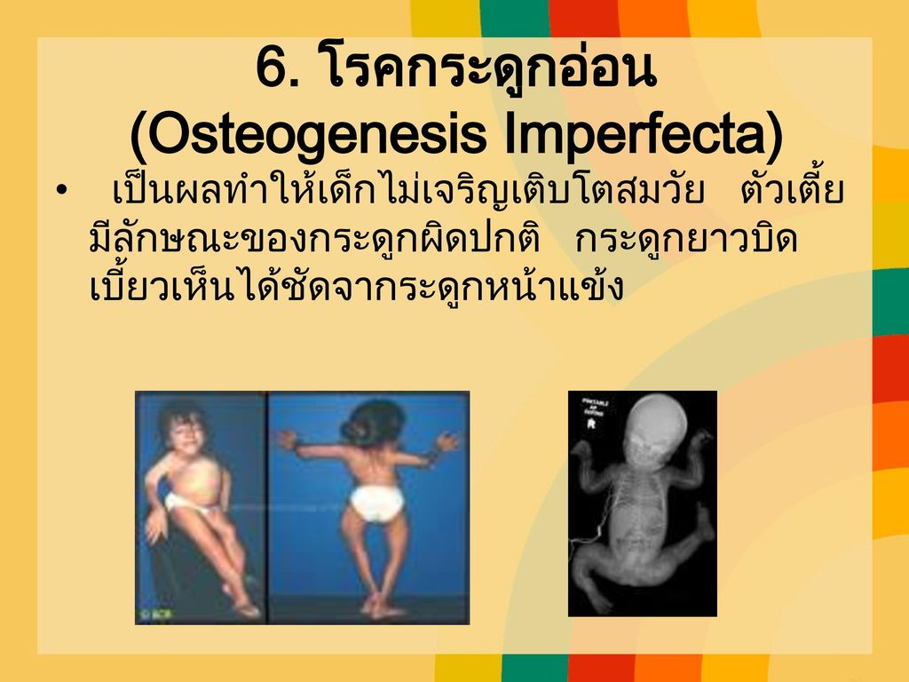 6. โรคกระดูกอ่อน (Osteogenesis Imperfecta)