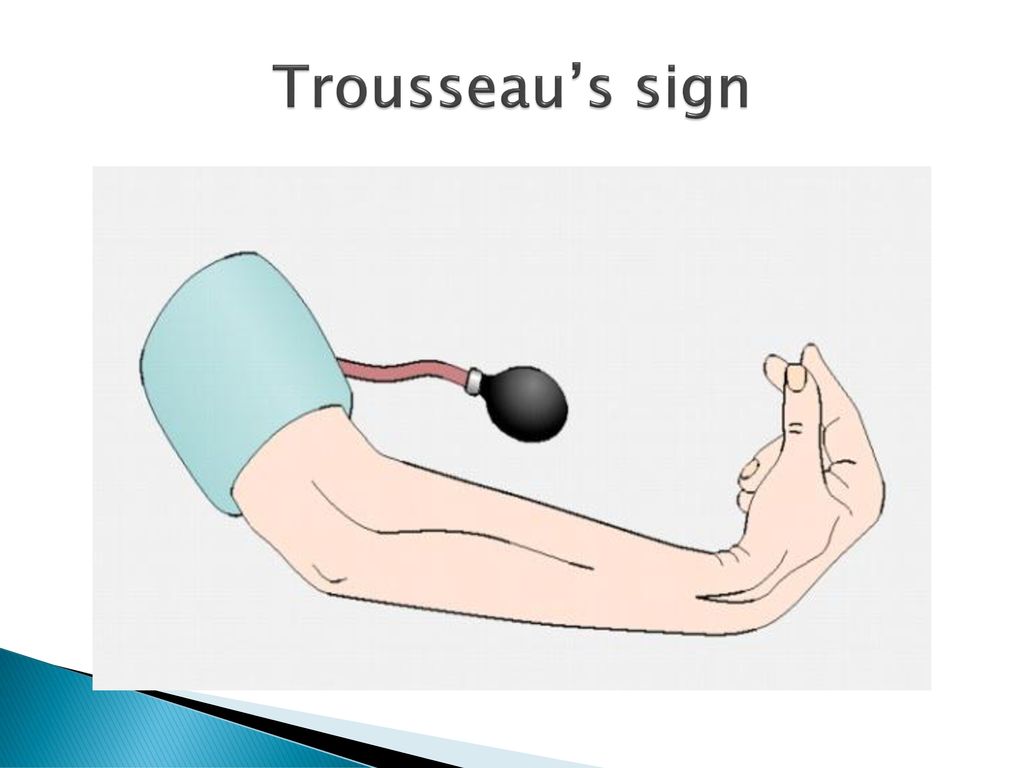 Trousseau’s sign