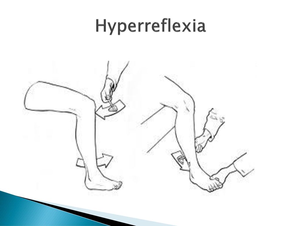 Hyperreflexia