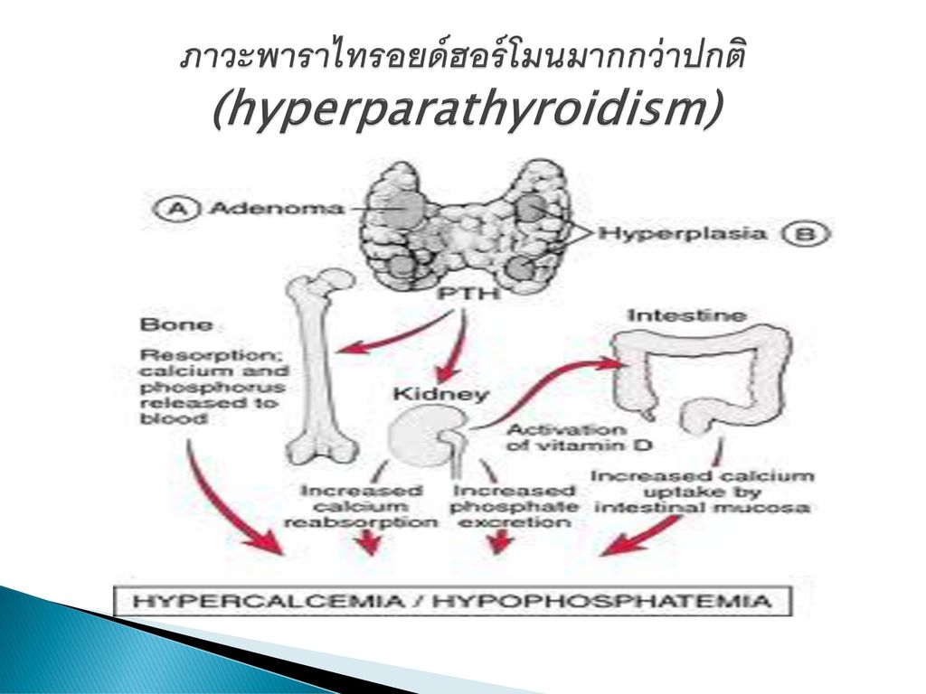 ภาวะพาราไทรอยด์ฮอร์โมนมากกว่าปกติ (hyperparathyroidism)